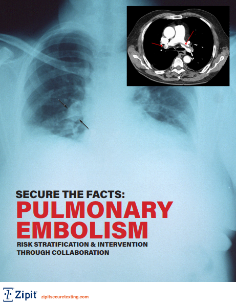 Pulmonary Embolism Risk Stratification through Collaboration